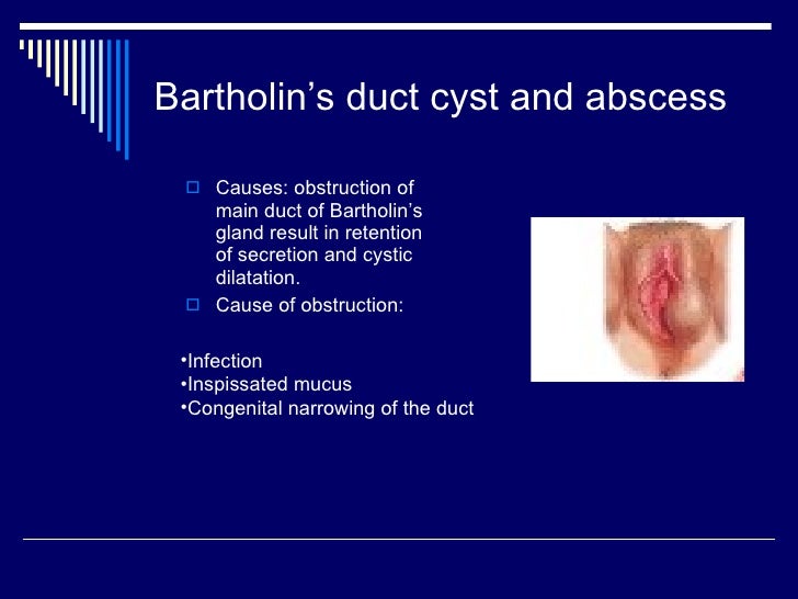 vaginal cyst cause Vaginal cyst cause